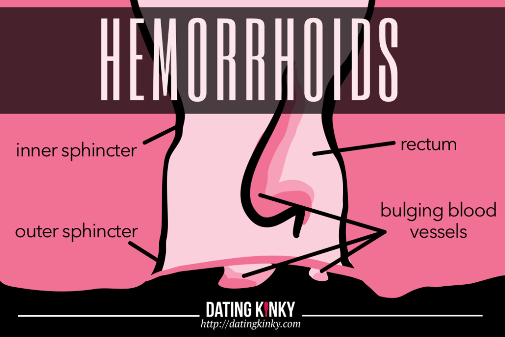 An image of the parts of the rectum and hemorrhoids. 
